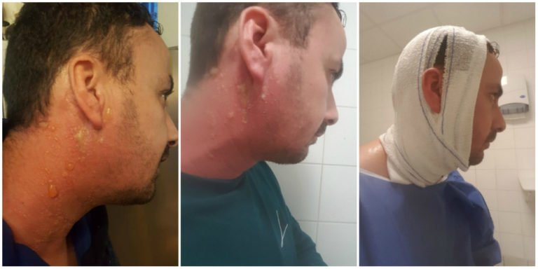 Un kabyle attaqué à l’acide par des algériens lors d’une manifestation à Paris